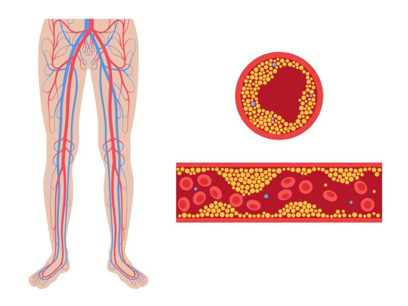 The Hidden Cost of Vascular Disease